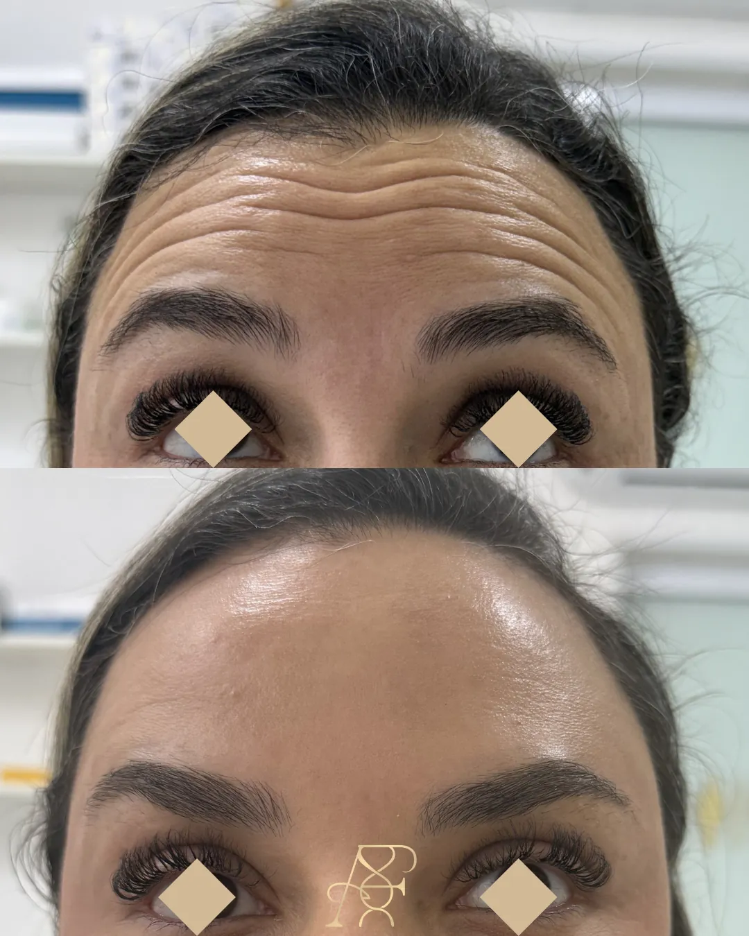 Antes e depois, toxina botulínica