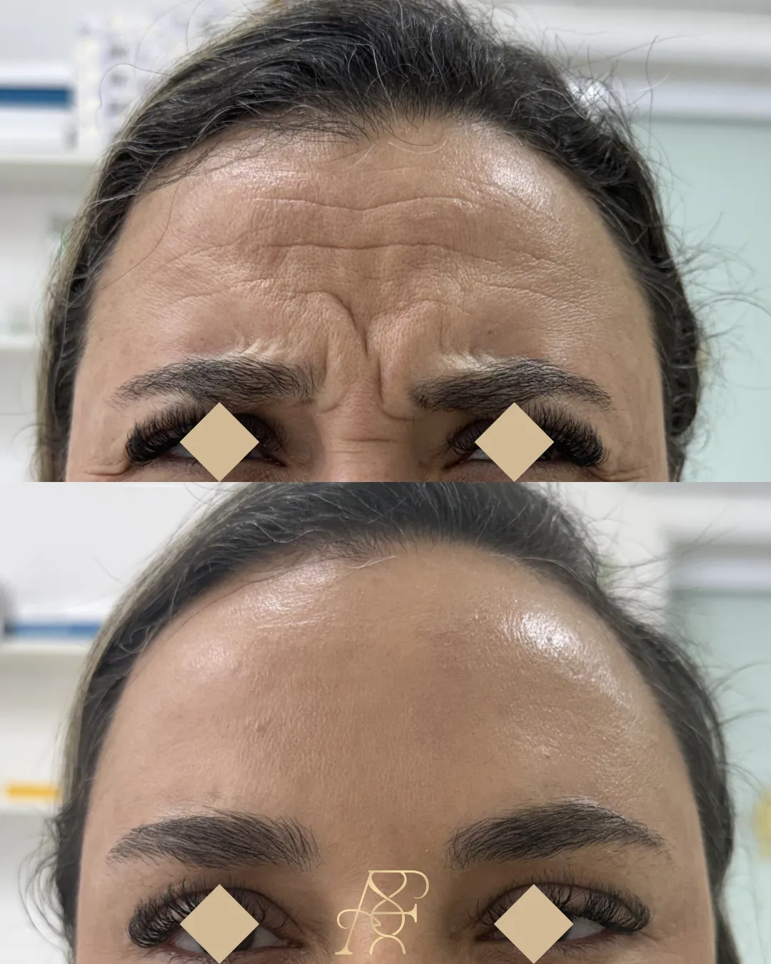Antes e depois, toxina botulínica