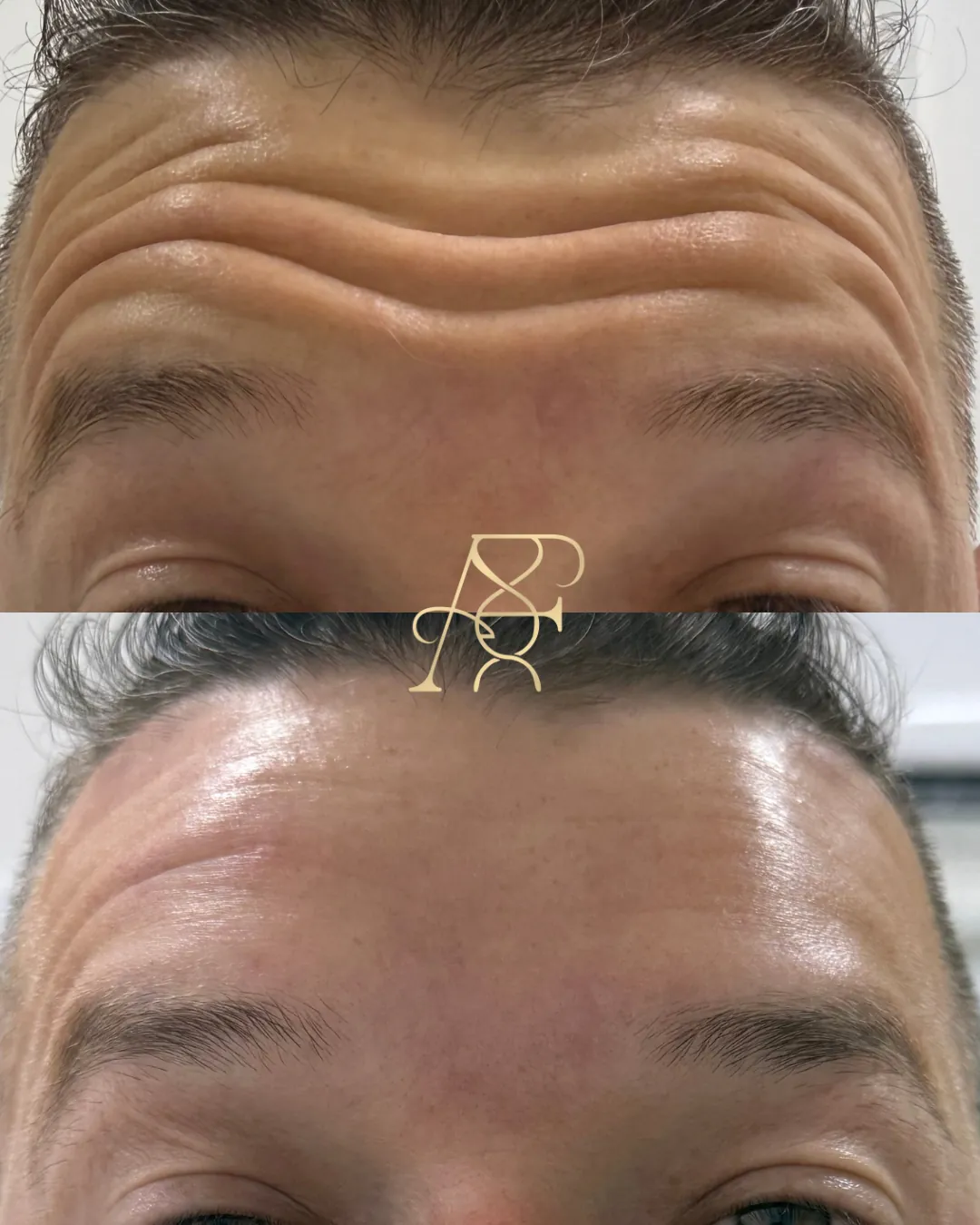 Antes e depois, toxina botulínica