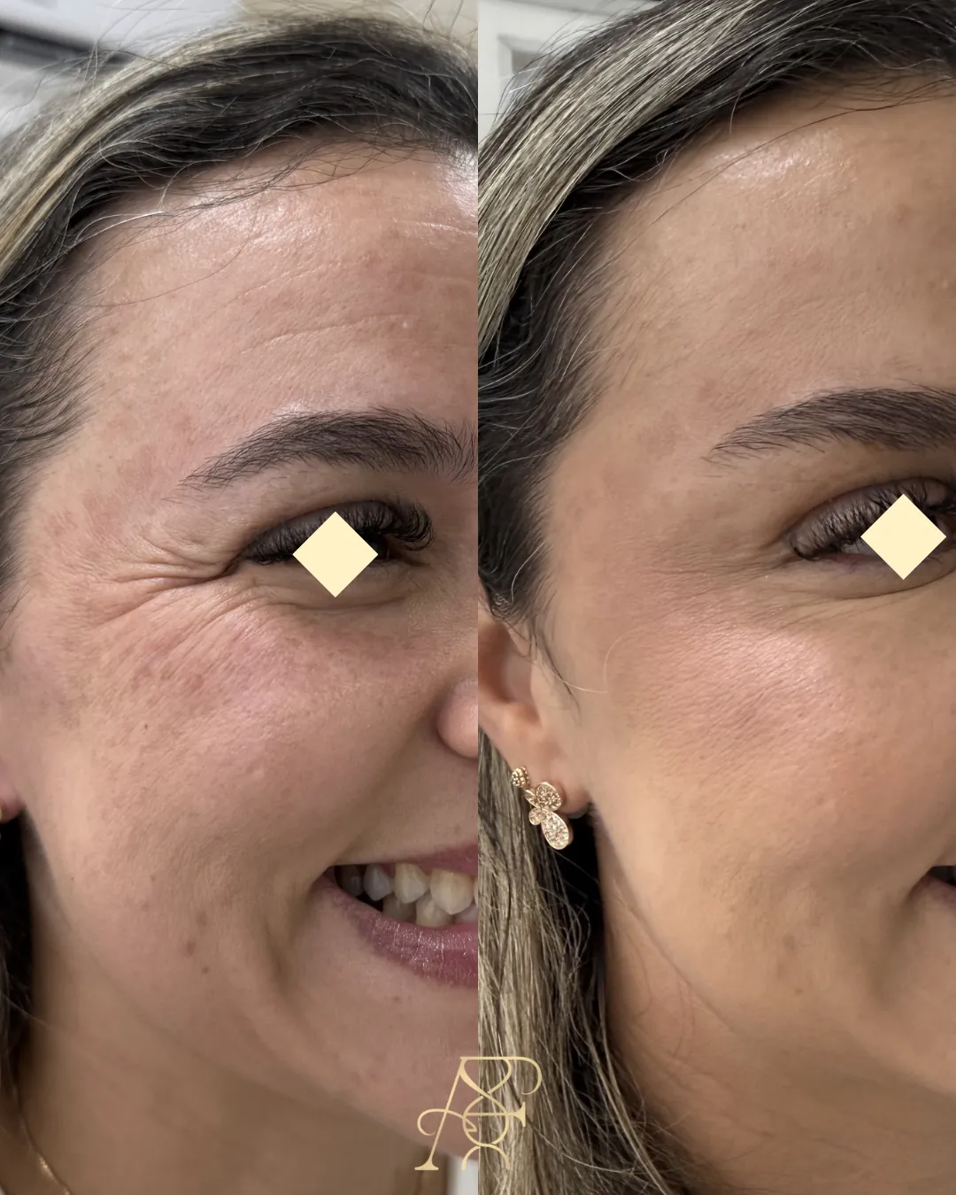 Antes e depois, toxina botulínica